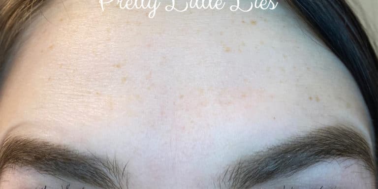 After Image: Botox - front