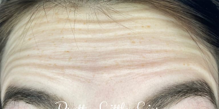 Before Image: Botox - front
