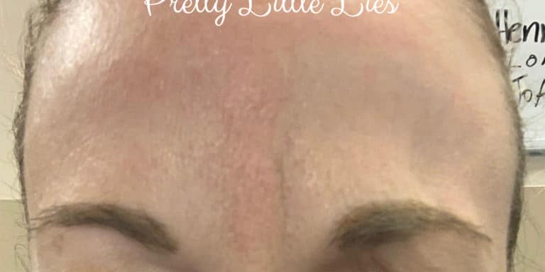 After Image: Botox - front