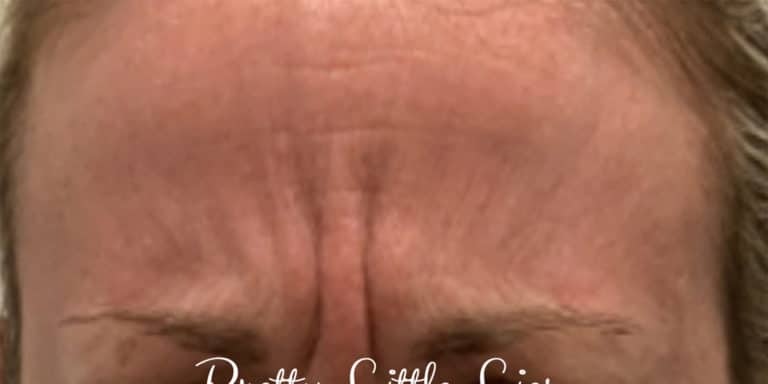 Before Image: Botox - front