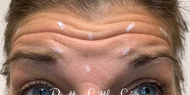 Before Image: Botox - front