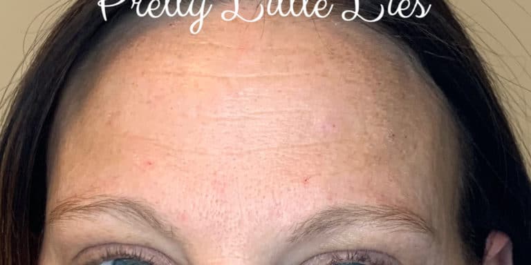 After Image: Botox - front
