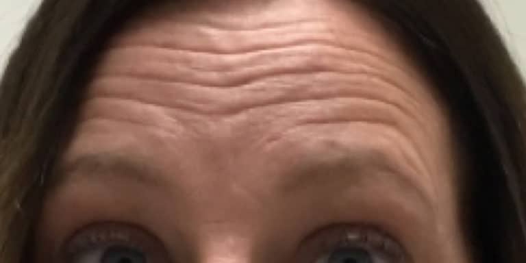 Before Image: Botox - front
