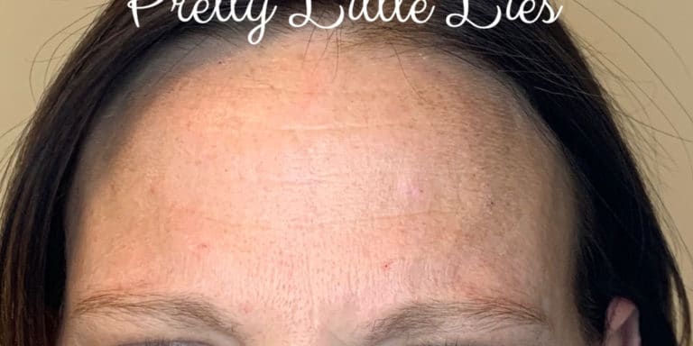 After Image: Botox - front