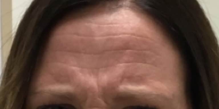 Before Image: Botox - front