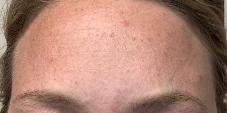 After Image: Botox - front