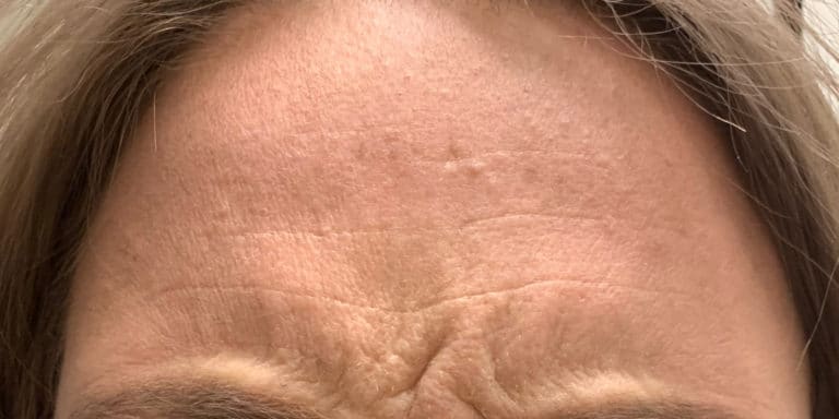 Before Image: Botox - front