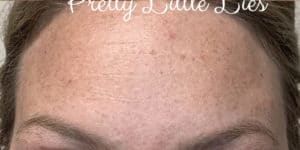 After Image: Botox