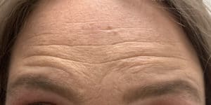 Before Image: Botox