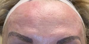 After Image: Botox