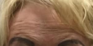 Before Image: Botox