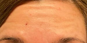 After Image: Botox