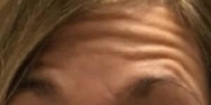 Before Image: Botox