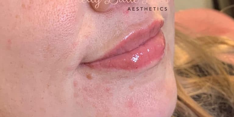 After Image: Lip Filler - right-front-oblique