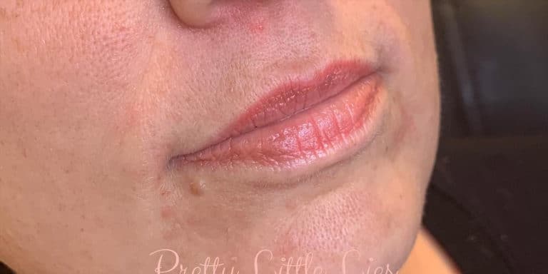 Before Image: Lip Filler - right-front-oblique