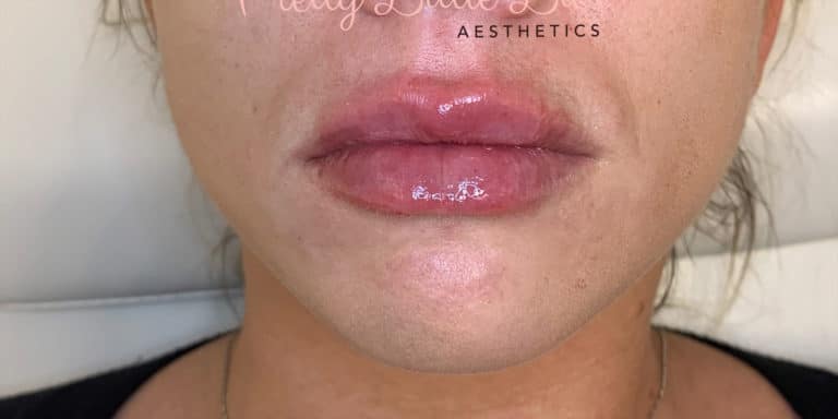After Image: Lip Filler - front