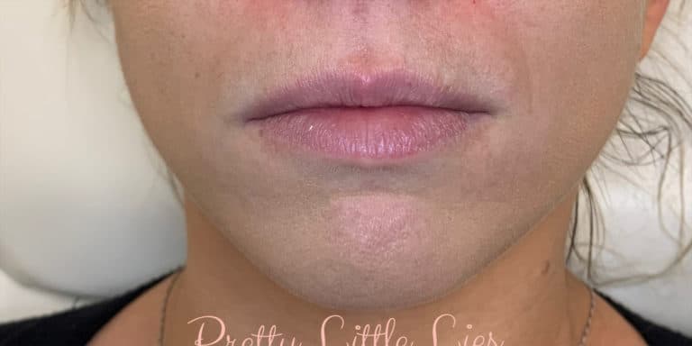 Before Image: Lip Filler - front