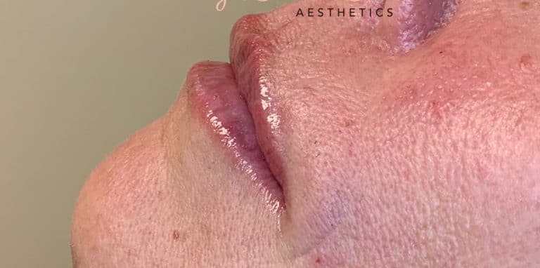 After Image: Lip Filler - left-side