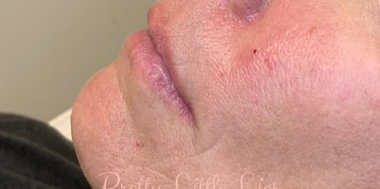 Before Image: Lip Filler - left-side