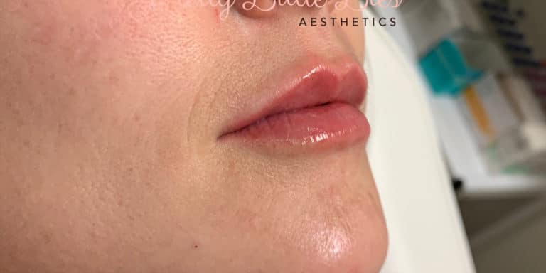 After Image: Lip Filler - right-front-oblique