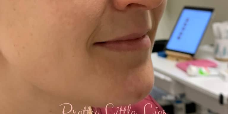 Before Image: Lip Filler - right-front-oblique
