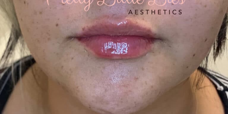 After Image: Lip Filler - front
