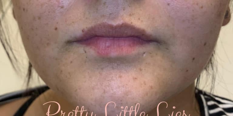 Before Image: Lip Filler - front