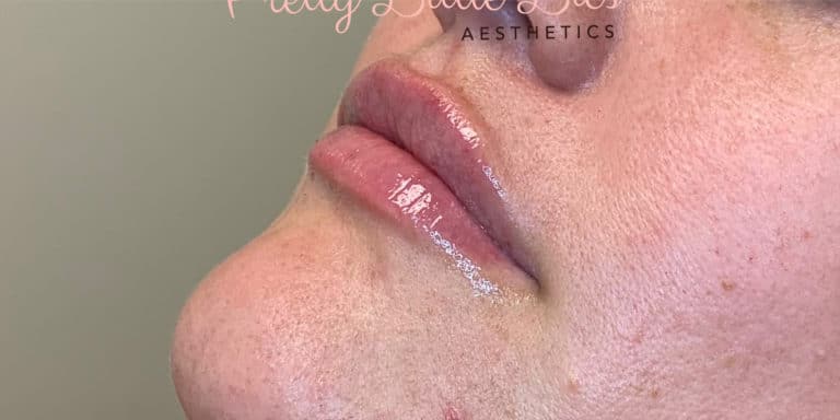 After Image: Lip Filler - left-front-oblique