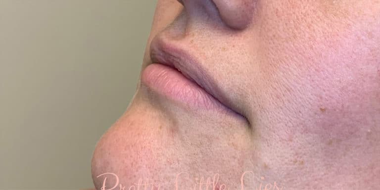 Before Image: Lip Filler - left-front-oblique