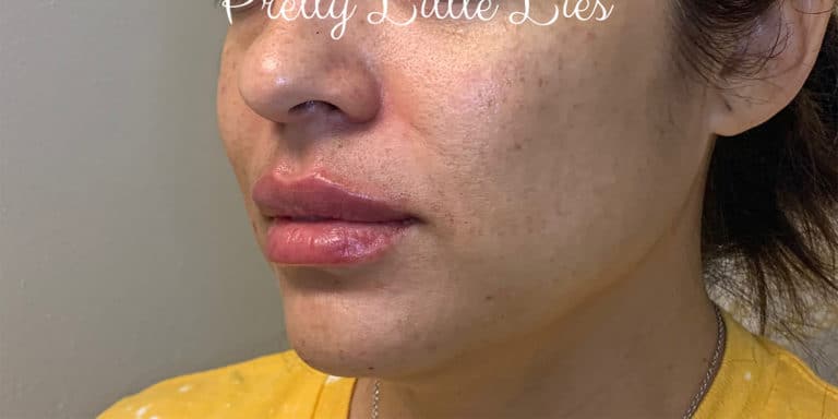 After Image: Lip Filler - left-front-oblique