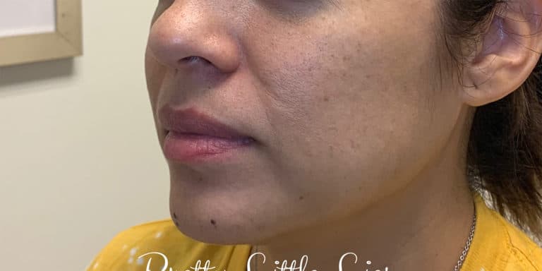Before Image: Lip Filler - left-front-oblique