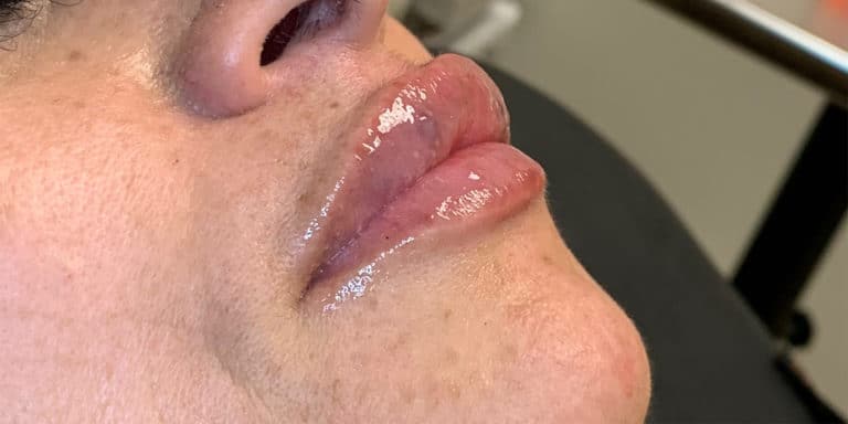 After Image: Lip Filler - right-front-oblique