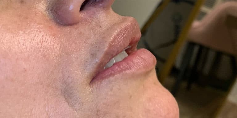 Before Image: Lip Filler - right-front-oblique