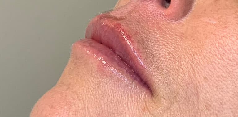 After Image: Lip Filler - left-front-oblique
