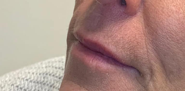 Before Image: Lip Filler - left-front-oblique