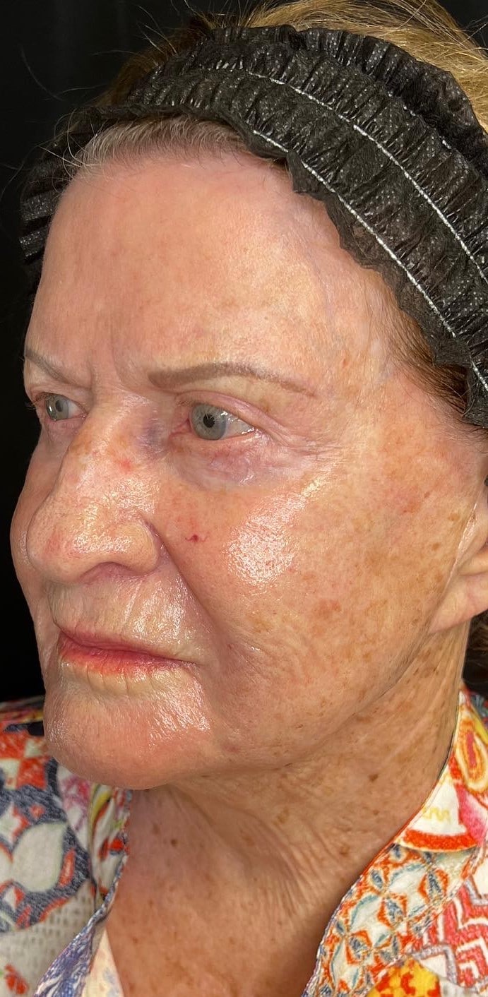 After Image: Sculptra - left-front-oblique
