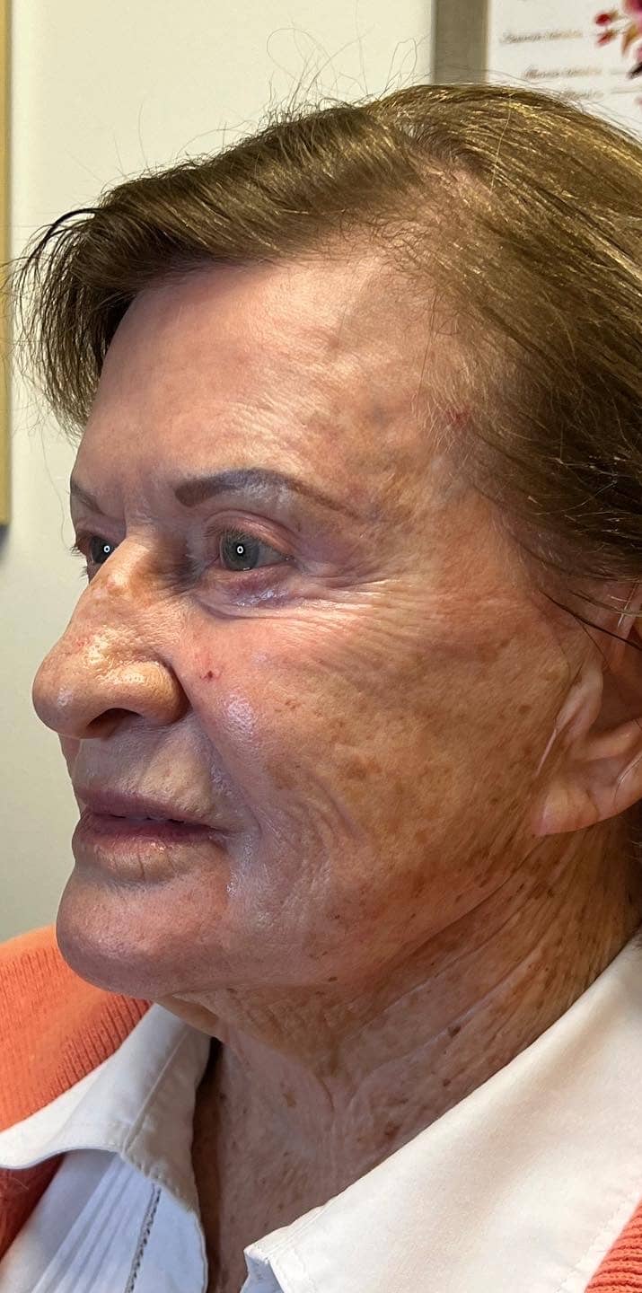 Before Image: Sculptra - left-front-oblique