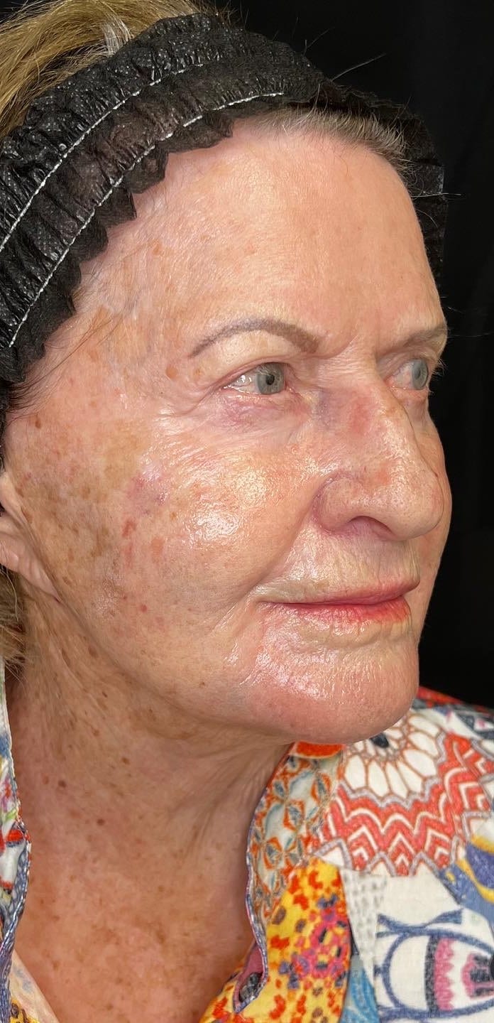 After Image: Sculptra - right-front-oblique