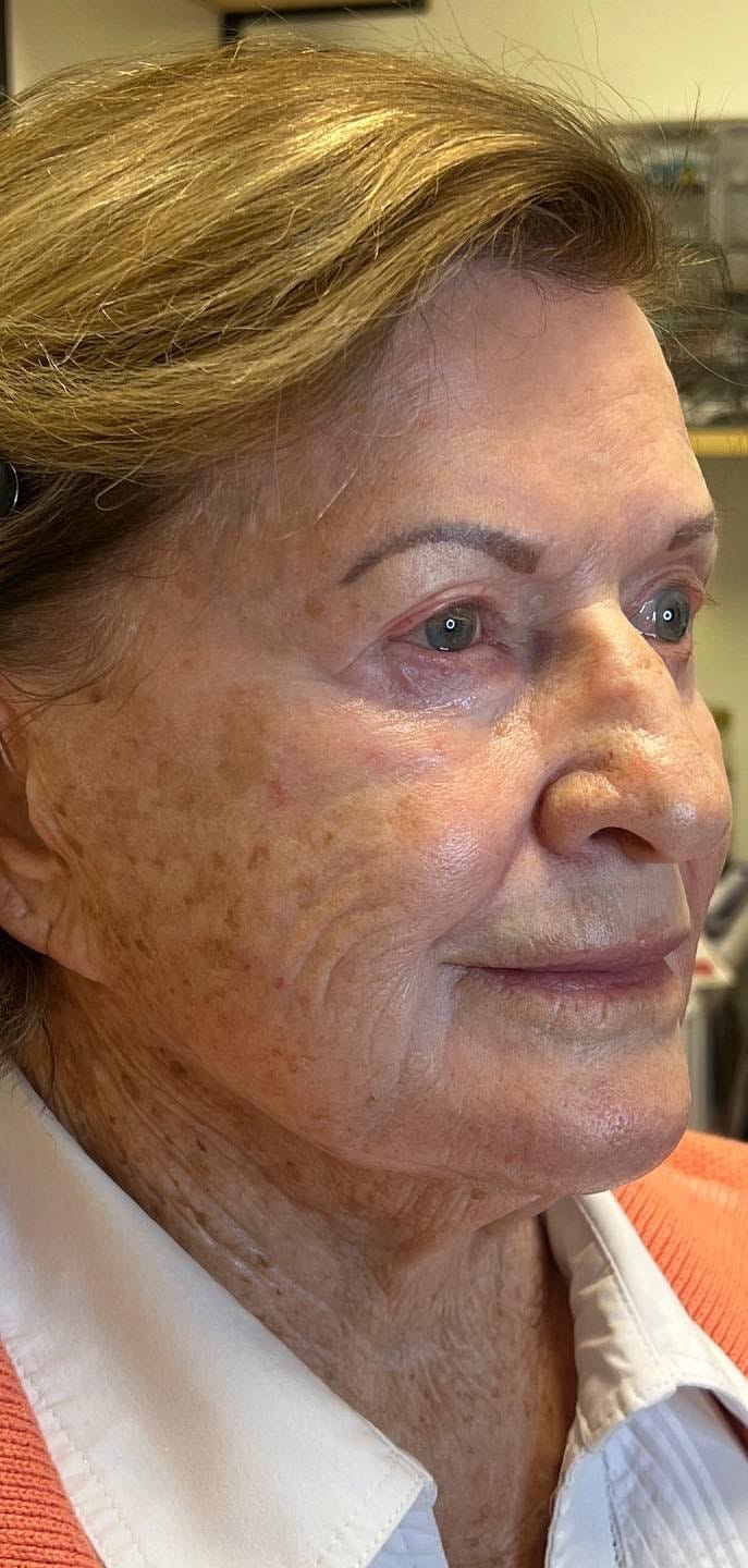 Before Image: Sculptra - right-front-oblique