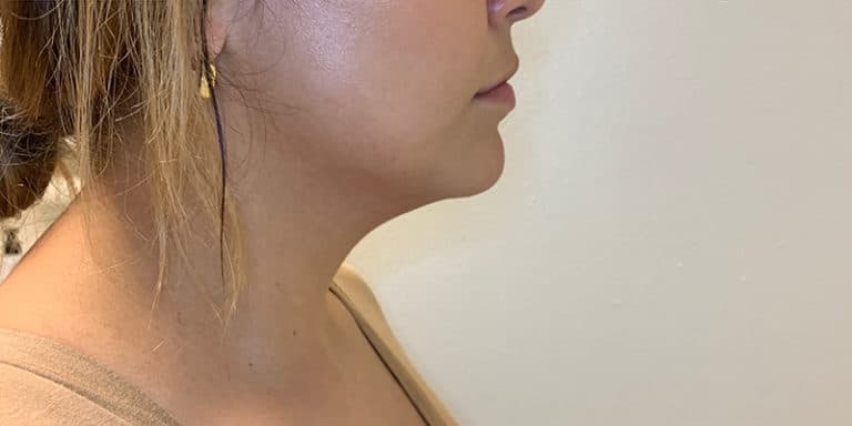 After Image: Kybella - right-side