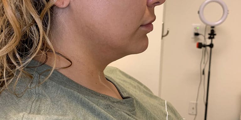Before Image: Kybella - right-side