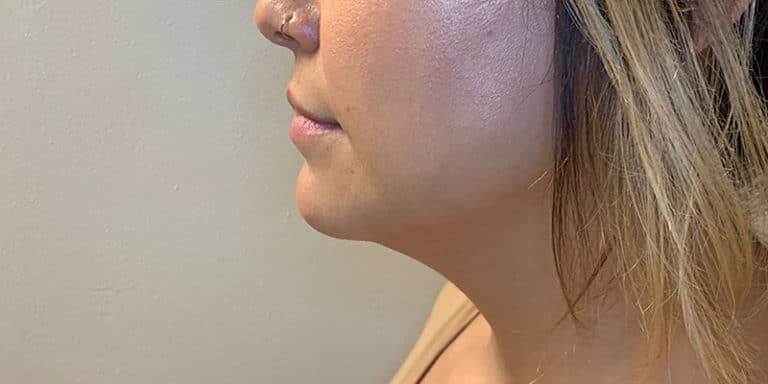 After Image: Kybella - left-side