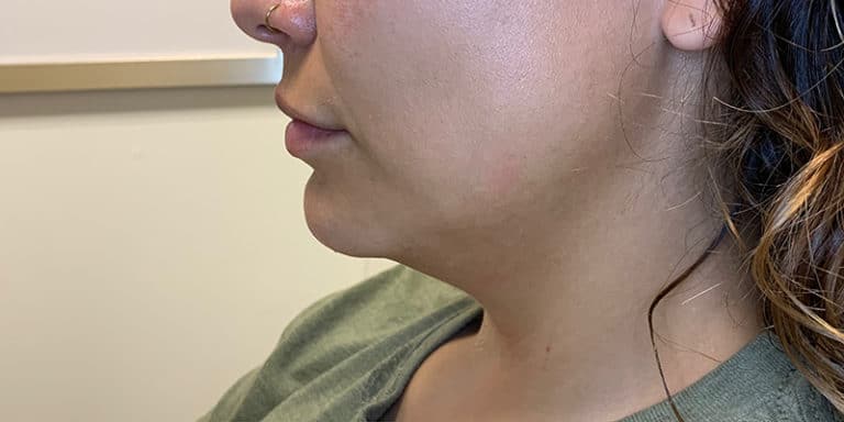 Before Image: Kybella - left-side