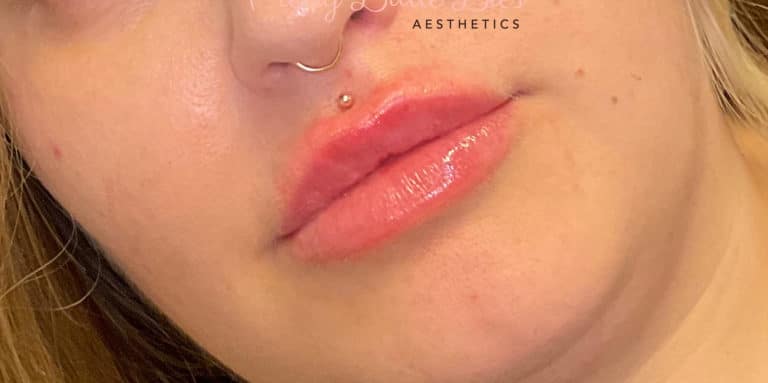 After Image: Lip Filler - front