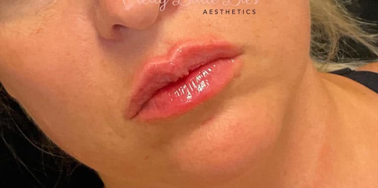 After Image: Lip Filler - front