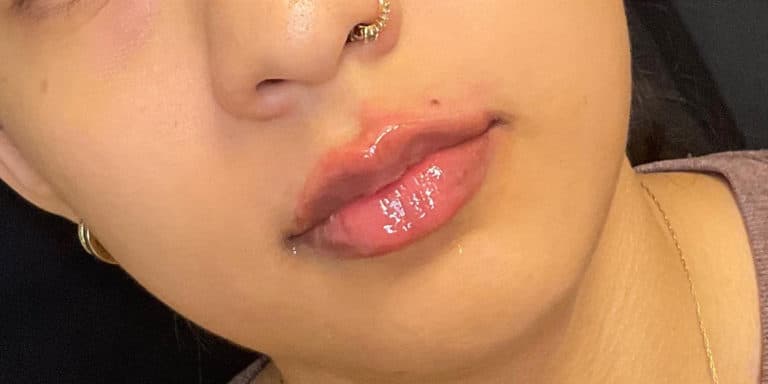 After Image: Lip Filler - front