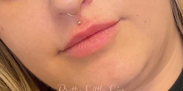 Before Image: Lip Filler - front