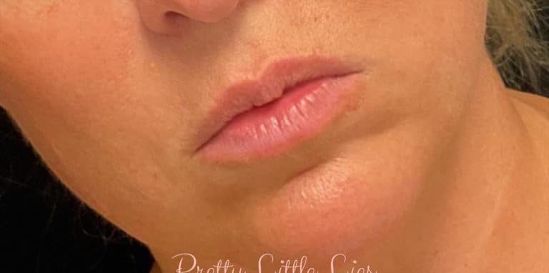 Before Image: Lip Filler - front