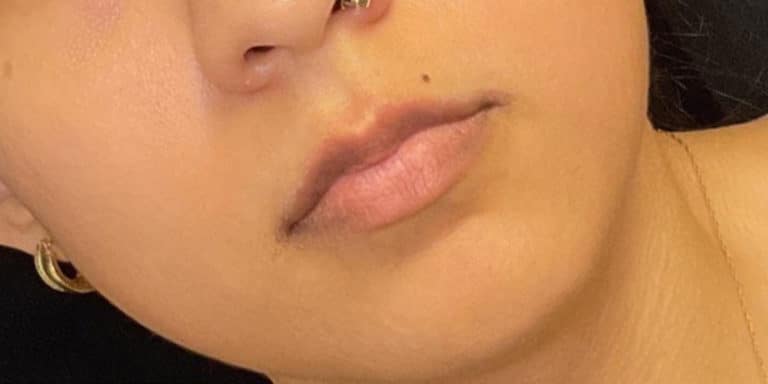 Before Image: Lip Filler - front