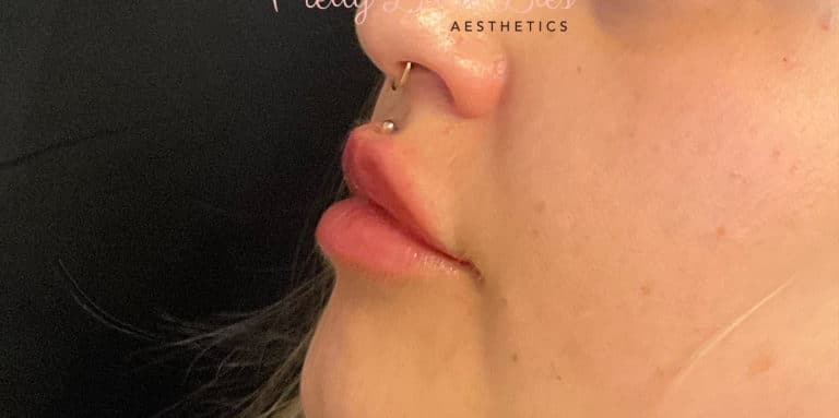 After Image: Lip Filler - left-front-oblique